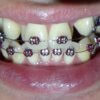 フィリピンで歯科矯正その11　歯を動かすスペースがない！
