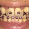 フィリピンで歯科矯正その13　歯が外側に広がってきました