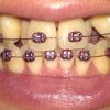 フィリピンで歯科矯正その１２　上あごを広げる器具を装着しました。